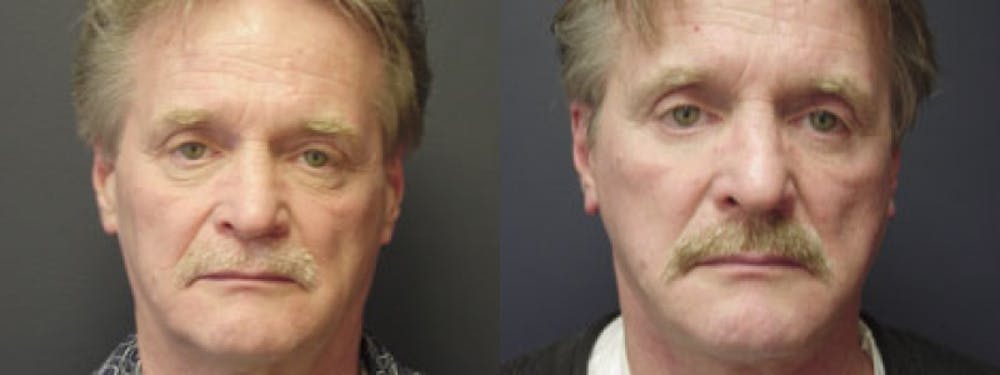 Facelift Before & After Gallery - Patient 5681480 - Image 1