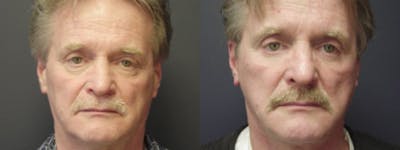 Facelift Before & After Gallery - Patient 5681480 - Image 1