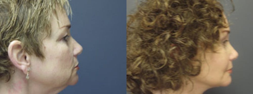 Facelift Before & After Gallery - Patient 5681479 - Image 2