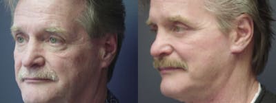 Facelift Before & After Gallery - Patient 5681480 - Image 2