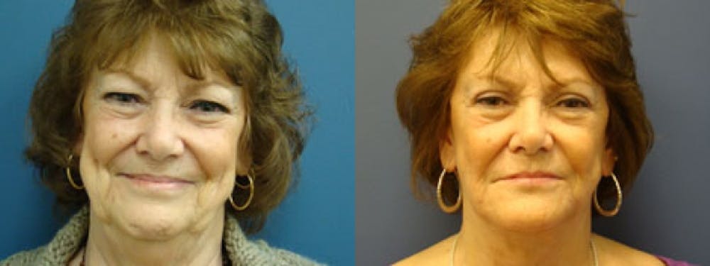 Facelift Before & After Gallery - Patient 5681481 - Image 1