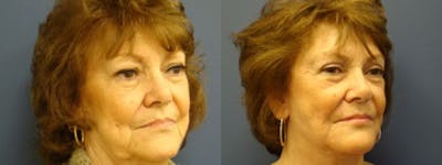 Facelift Before & After Gallery - Patient 5681481 - Image 2