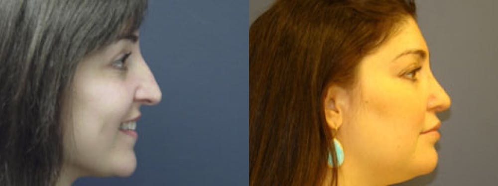 Rhinoplasty Before & After Gallery - Patient 5681486 - Image 1