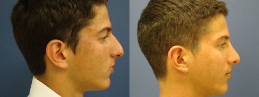 Rhinoplasty Before & After Gallery - Patient 5681487 - Image 1