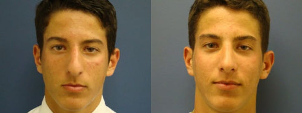 Rhinoplasty Before & After Gallery - Patient 5681487 - Image 2