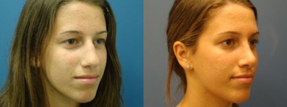 Rhinoplasty Before & After Gallery - Patient 5681488 - Image 1