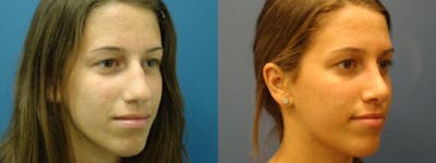Rhinoplasty Before & After Gallery - Patient 5681488 - Image 1