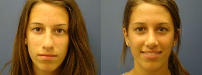 Rhinoplasty Before & After Gallery - Patient 5681488 - Image 2