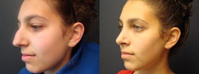 Rhinoplasty Before & After Gallery - Patient 5681489 - Image 1
