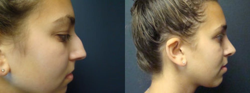 Rhinoplasty Before & After Gallery - Patient 5681489 - Image 2