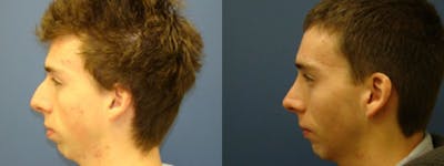 Rhinoplasty Before & After Gallery - Patient 5681490 - Image 1