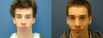 Rhinoplasty Before & After Gallery - Patient 5681490 - Image 2