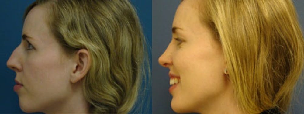 Rhinoplasty Before & After Gallery - Patient 5681491 - Image 1