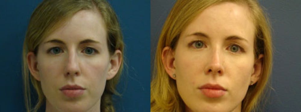 Rhinoplasty Before & After Gallery - Patient 5681491 - Image 2