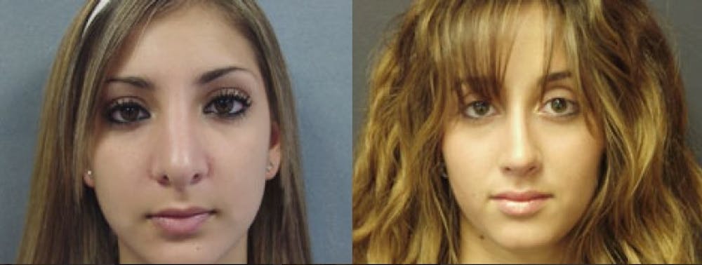 Rhinoplasty Before & After Gallery - Patient 5681492 - Image 1
