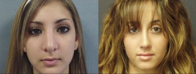 Rhinoplasty Before & After Gallery - Patient 5681492 - Image 1