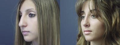 Rhinoplasty Before & After Gallery - Patient 5681492 - Image 2