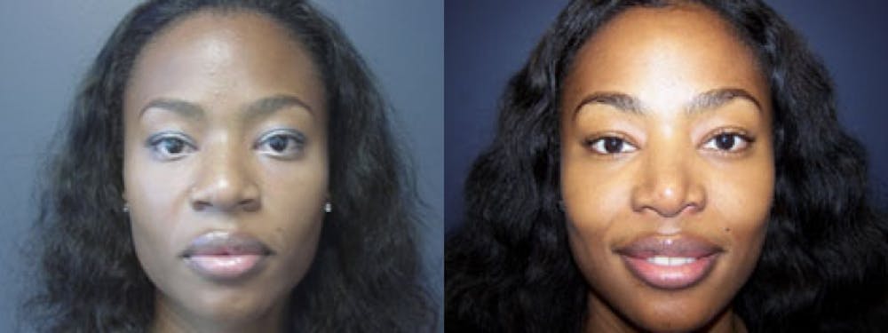 Rhinoplasty Before & After Gallery - Patient 5681493 - Image 1