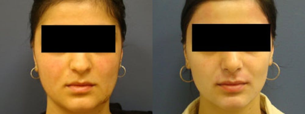 Rhinoplasty Before & After Gallery - Patient 5681494 - Image 1