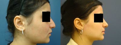 Rhinoplasty Before & After Gallery - Patient 5681494 - Image 2