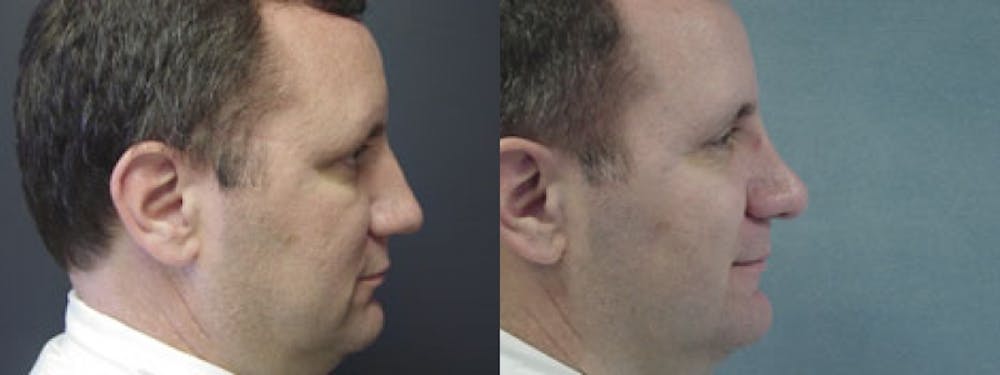 Rhinoplasty Before & After Gallery - Patient 5681495 - Image 1
