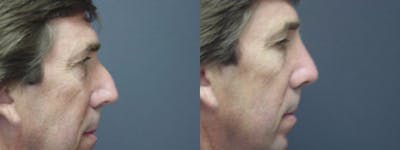 Rhinoplasty Before & After Gallery - Patient 5681495 - Image 2