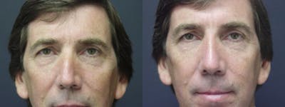 Rhinoplasty Before & After Gallery - Patient 5681496 - Image 1