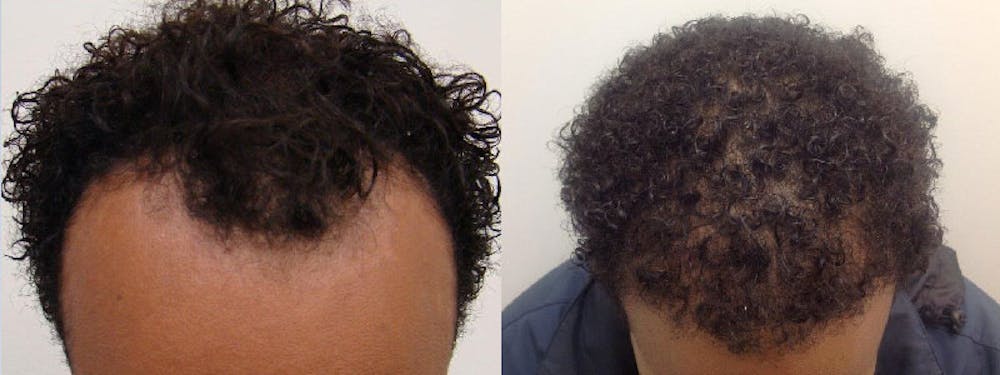 Hair Restoration