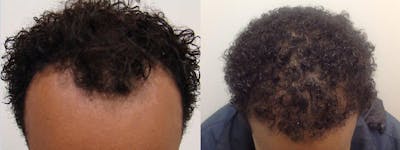 Hair Restoration Before & After Gallery - Patient 5681497 - Image 1