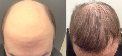 Hair Restoration Before & After Gallery - Patient 5681498 - Image 1