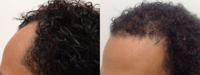 Hair Restoration Before & After Gallery - Patient 5681497 - Image 2