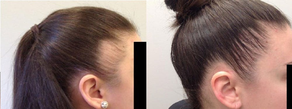 Hair Restoration Before & After Gallery - Patient 5681499 - Image 1