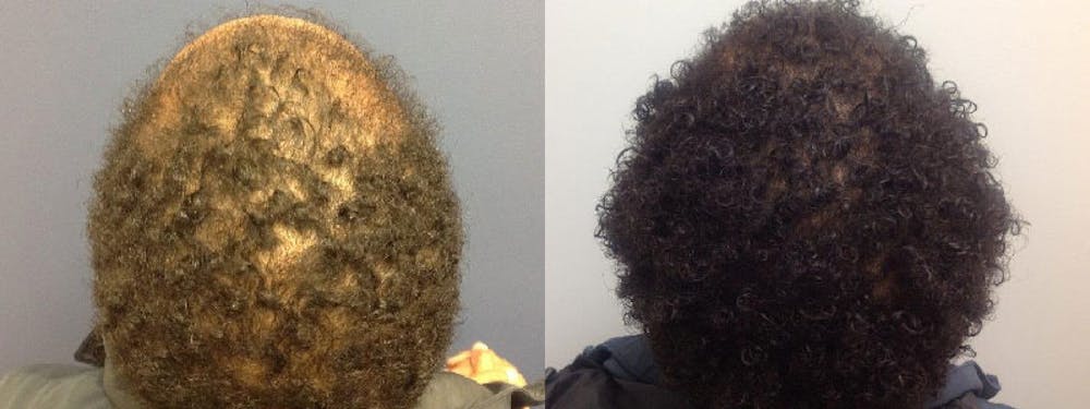 Hair Restoration Before & After Gallery - Patient 5681497 - Image 3