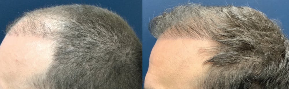 Hair Restoration Before & After Gallery - Patient 57557030 - Image 1