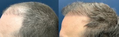 Hair Restoration Before & After Gallery - Patient 57557030 - Image 1