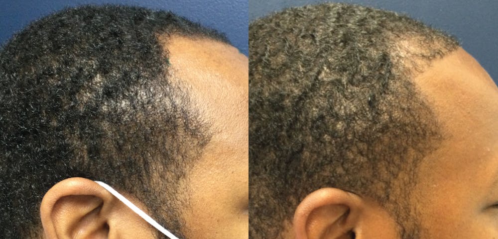 Hair Restoration Before & After Gallery - Patient 57557029 - Image 1