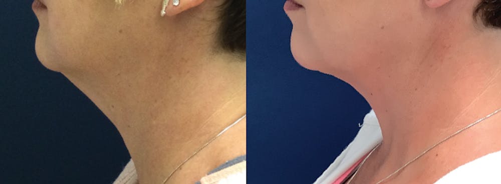 Before & After Liposuction in Pittsburgh