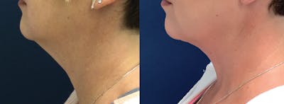 Liposuction Before & After Gallery - Patient 57557047 - Image 1