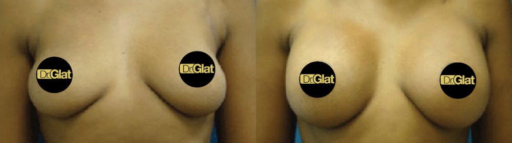 Breast Augmentation Before & After Gallery - Patient 57557037 - Image 1