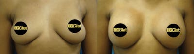 Breast Augmentation Before & After Gallery - Patient 57557037 - Image 1