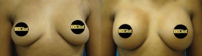 Breast Augmentation Before & After Gallery - Patient 57557037 - Image 1