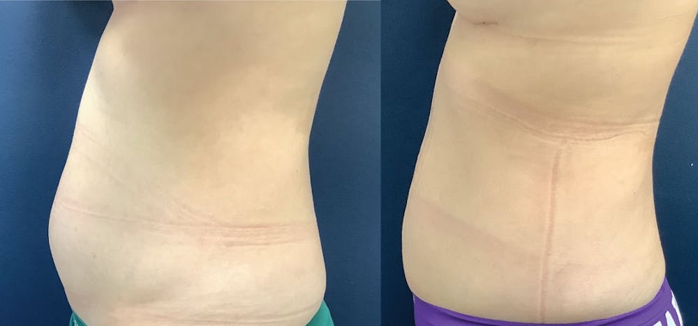 Liposuction Before & After Gallery - Patient 61109615 - Image 1