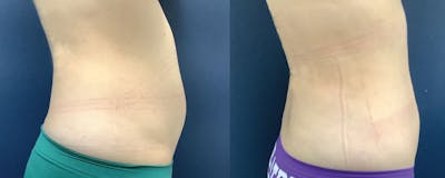 Liposuction Before & After Gallery - Patient 61109615 - Image 2