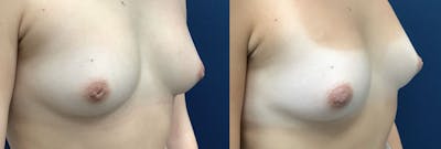 Inverted Nipple Repair Before & After Gallery - Patient 61109621 - Image 1