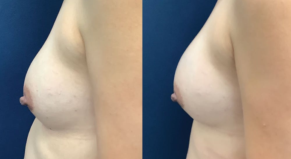 Breast Revision Before & After Gallery - Patient 61109624 - Image 1