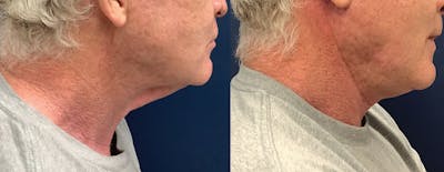Lower Face  Before & After Gallery - Patient 68507521 - Image 1