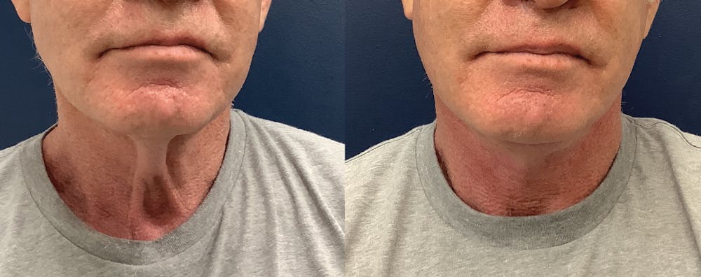 Lower Face  Before & After Gallery - Patient 68507521 - Image 2