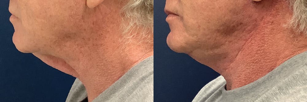 Lower Face  Before & After Gallery - Patient 68507521 - Image 3