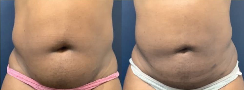 Liposuction Before & After Gallery - Patient 74784694 - Image 1