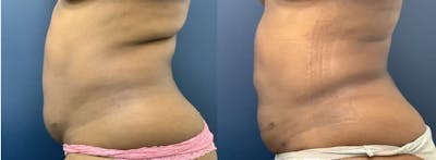 Liposuction Before & After Gallery - Patient 74784694 - Image 2
